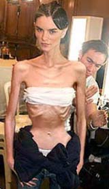 anorexia1